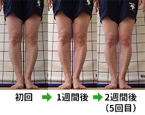O脚矯正プログラム